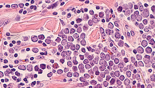 Merkel cell cancer cells